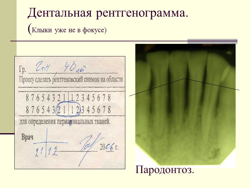 Дентальная рентгенограмма.        (Клыки уже не в фокусе)